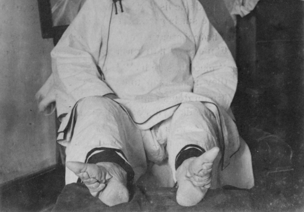 A black and white image shows the severely deformed "lotus feet" of an individual, illustrating the physical consequences of Lotus Feet History and the painful practice of foot binding.