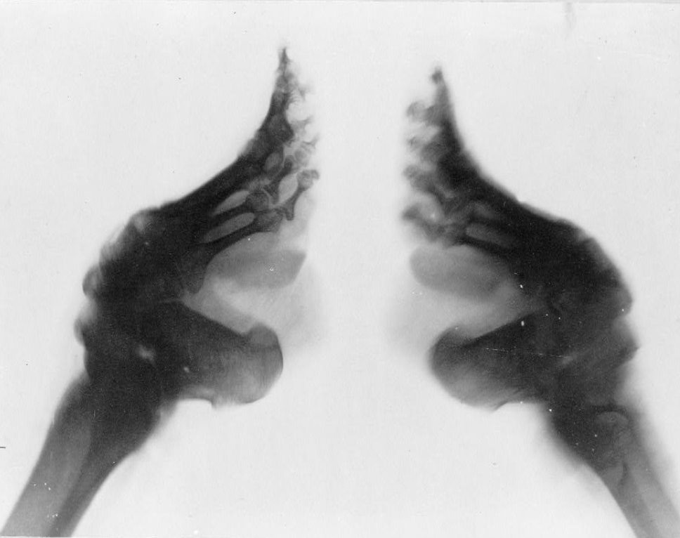 An X-ray image reveals the severe bone deformation and structural changes in a pair of feet, graphically illustrating the long-term physical impact and Chinese Foot Binding Pain.